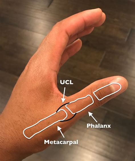 thumb ligament tear